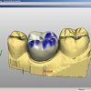 CAD/CAM در دندانپزشکی مدرن