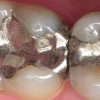 بررسی جامع آمالگام دندانپزشکی: ترکیب، کاربردها، مزایا و معایب آمالگام