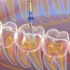 وضعیت سلامت دهان و دندان در ایران و چالشهای موجود Endodontics