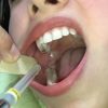 تکنیک بلاک مندیبل (Mandibular Block) در کودکان تکنیک بلاک مندیبل (Mandibular Block) در کودکان