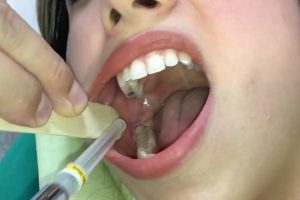 تکنیک بلاک مندیبل (Mandibular Block) در کودکان