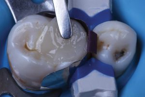 آموزش مواد دندانپزشکی